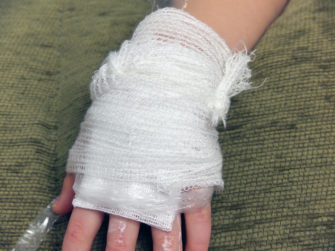 علاج حروق الجلد السطحية في المنزل لتخفيف الألم 1